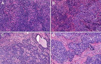 The Prognostic Impact of Combined Tumor-Infiltrating Lymphocytes and Pretreatment Blood Lymphocyte Percentage in Locally Advanced Nasopharyngeal Carcinoma